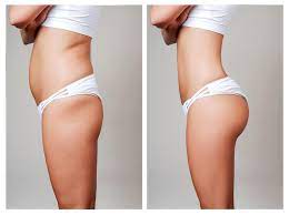 Buttock Lift in Dubai