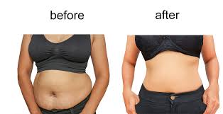 Bariatric Lap Band Surgery - Change Your Physical Appearance