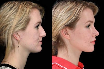 How to Get Rid of Chin Fat - Options to Try