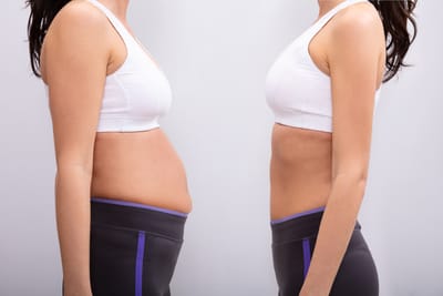 Tummy Tuck Surgery - Precautions to Take Before and After the Procedure