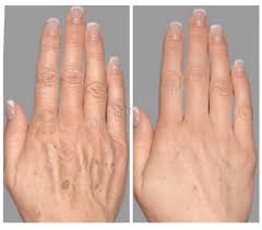 Vein Laser Therapy For Spider Veins