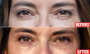 All Eyes See The Benefits of Blepharoplasty Surgery