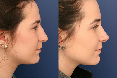 Rhinoplasty: The Facts