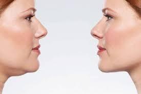 General Information About Chin Liposuction