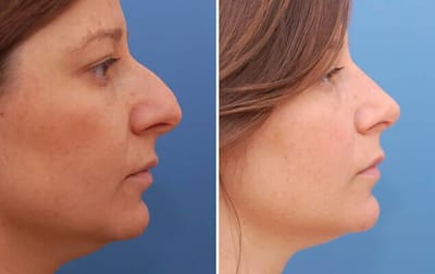 Liposuction - Solving Turkey Neck Syndrome