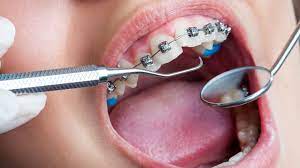 What Is Orthodontics and What Are Orthodontic Treatments?