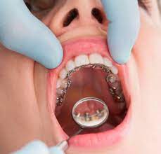 How To Take Care of Lingual Braces