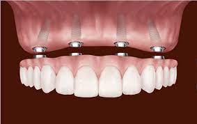 Dental Implants - Why They Work