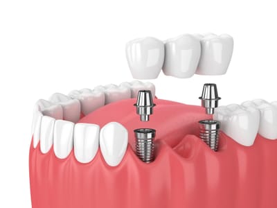 Where Can I Get Really Cheap Dental Implants?