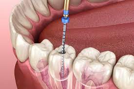 When a Root Canal is Necessary