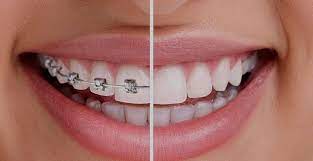 The Importance of Orthodontic Care to Overall Health