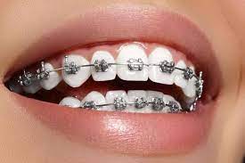 Why Dental Braces Can Be Important For Your Teeth