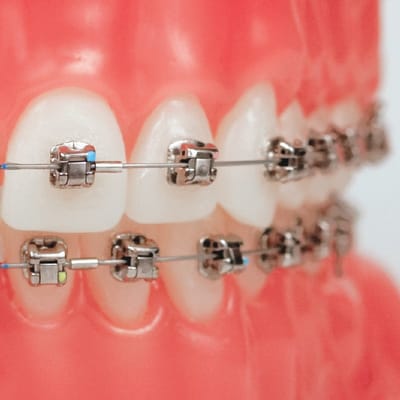 Different Types Of Braces Suited For Your Smile