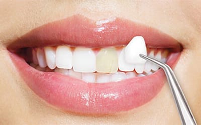 How to Care for Your Porcelain Dental Veneers