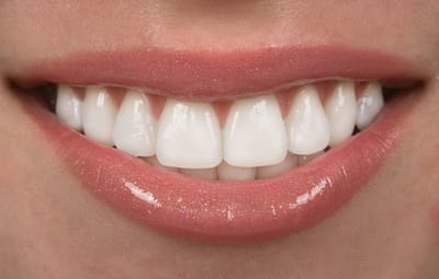 What Are Dental Veneers?