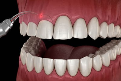 Gum Lift - Get Rid of Many Dental Diseases