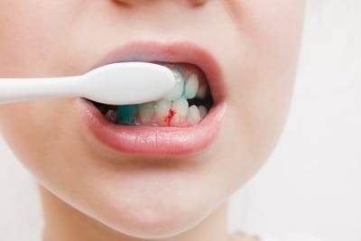 Bleeding Gums - Make Sure the Family is Safe From Bleeding Gums