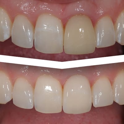 Gum Problems and Dental Crowns