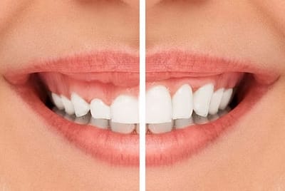 Do You Have a Gummy Smile? What You Can Do About It