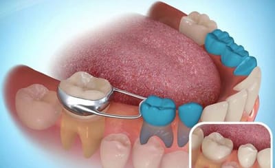 Periodontal Disease - Maintenance