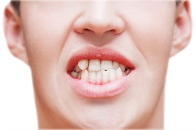 Invisalign - A Teeth Straightening Procedure
