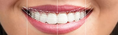 Clear Braces: Are They Suitable For You?