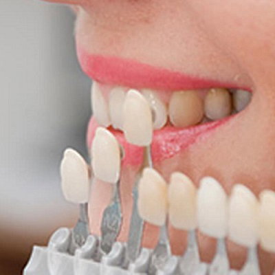 Basic Information About Dental Veneers