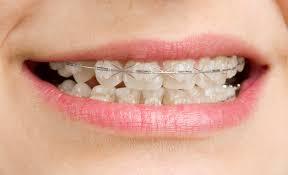 Caring for Your Invisalign Aligners and Your Teeth