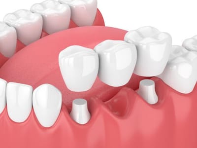 Common Problems With Regard To Dental Crowns And Bridges