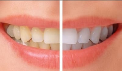 Hydrogen Peroxide Teeth Whitening - What You Need to Know