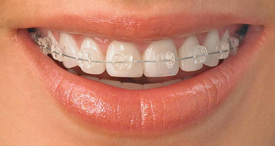 Information On Invisalign Braces