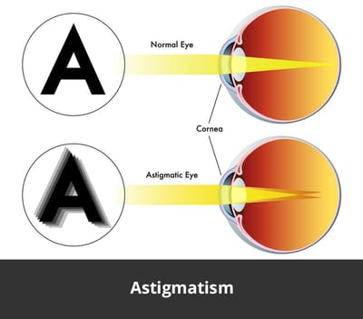 Astigmatizem