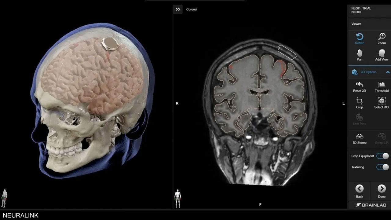 ماسك يعلن نجاح زرع شريحة دماغية في أول إنسان