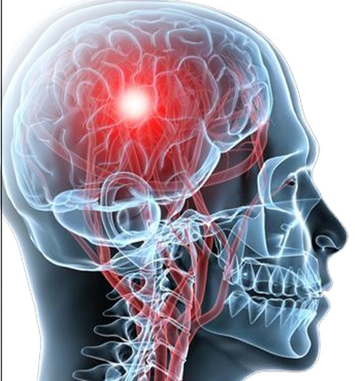 It affects about 15 million people annually.. World Stroke Day