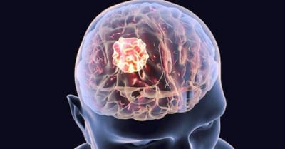 اختبار نوعي يكشف أورام الدماغ مبكراً