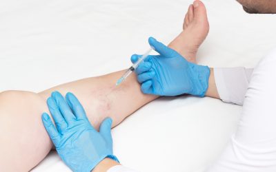 What Are The Treatment For Spider Veins And Leg Cramps?