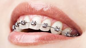 Metal Braces image