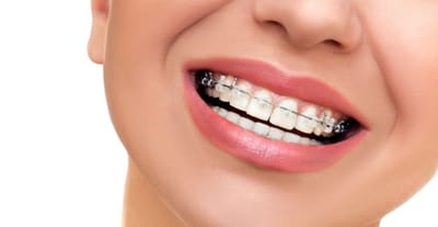 Ceramic Braces image