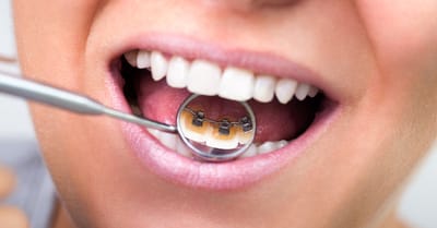 Lingual Braces image