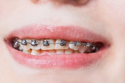 Self-Ligating Braces image