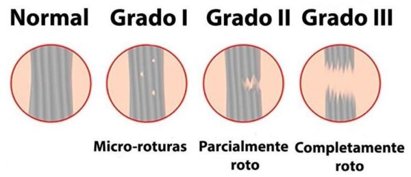 El tratamiento fisioterapéutico para esguince de tobillo