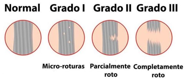 El tractament fisioterapèutic per a esquinç de turmell
