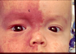 Congenital-Glaucoma image