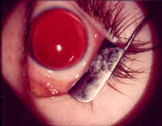 Congenital-Glaucoma image