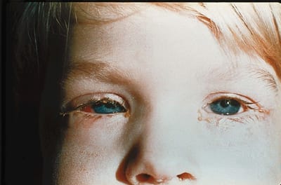 Conjunctivitis image