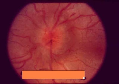 Papilloedema image