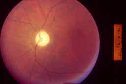 OPTIC ATROPHY image