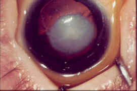 Uniocular-cataract image