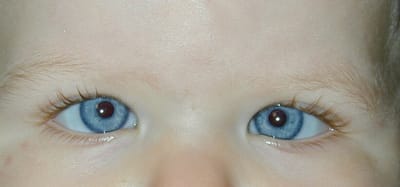 STRABISMUS image