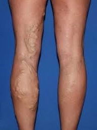 Varicorin medications to treat varicose veins